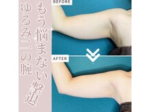 ラグラン銀座メディカルエステ 高輪ゲートウェイ店/痩身/プヨ肉+振袖肉集中！