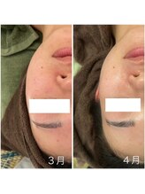 ヴィヴ コレビ(VIV COREBI)/浮腫み除去リフトアップで小顔☆