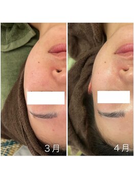 ヴィヴ コレビ(VIV COREBI)/浮腫み除去リフトアップで小顔☆