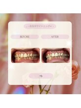 プラスビー 2号店(+b)/ホワイトニングビフォーアフター