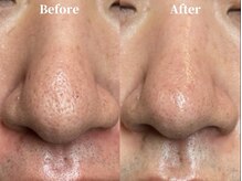 美意識/毛穴の開き・黒ずみも解消！