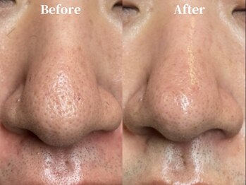 美意識/毛穴の開き・黒ずみも解消！