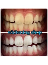 ホワイトニングショップ 越谷店/