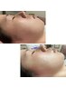 再来【5週間以内】定期ケア　フェイシャルwax＋肩首オイル付90分　¥11000