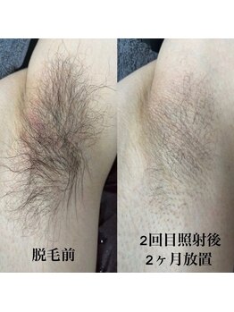 グロワール(gloire)/ワキ脱毛