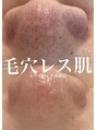 ルアナアイナ(Luana Aina) ハーブピーリング/剥離しないハーブピーリング/毛穴ケア