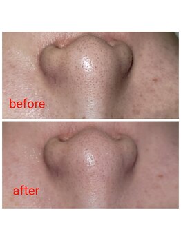 リヒト(LiHiTO)/毛穴洗浄