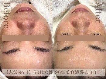 ディレイア ザ コスメ 有楽町マルイ店(direia the cosme)/月1～2回/くすみ［有楽町］