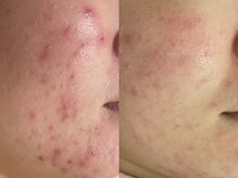 ラディアントモア(radiant more)/ニキビケア