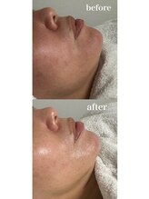 テンディ(TenD.)/レストセルトリートメント