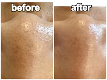 ベルージュ(Bellege)/毛穴ケアコース