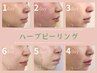 【肌質改善No,1人気】DT有*ハーブピーリング ～ワンランク上のお肌へ