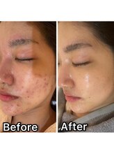 ドクタースキン(Dr.skin) 肌荒れ 徹底改善