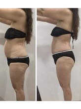 レミュー/レミューダイエット症例