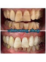 ホワイトニングショップ 越谷店/