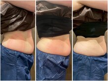 ビュウナ 銀座(BEAUNA)/脂肪冷却/frozen8