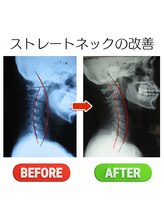 ヘンミ/ストレートネック矯正