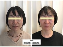 ナチュレアンドメディカ(Nature&Medica)/【たるみ＆小顔】ウルトラリフト