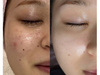 フェイスプラスリフ(FACE+RiF)/肌荒れ 敏感肌 赤み