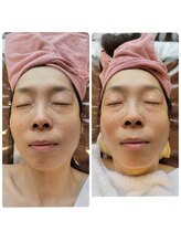キミーエステティックサロン(kimmy esthetic salon)/キュッと小顔フェイシャルコース
