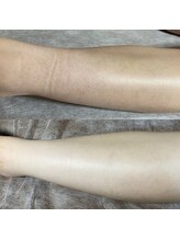 リラチル(relachill)/足脱毛