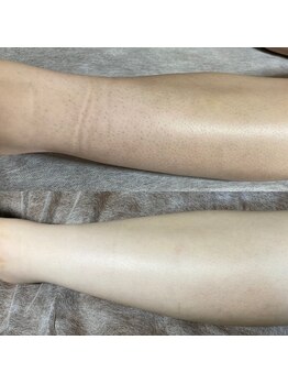 リラチル(relachill)/足脱毛