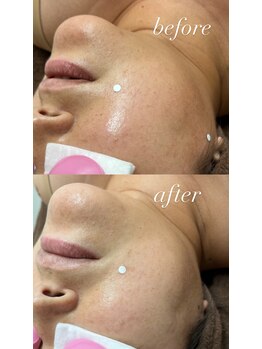 スマイルネイル(SMILE NAIL)/光フェイシャル