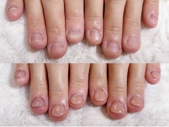 グラシナ なんば店/深爪/自爪育成/フィルイン