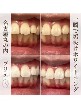 ブリエ(BRILLER)/高効果ホワイトニング　１デイ