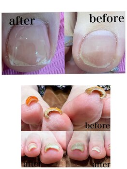 ルリアン(Le Lien)の写真/痛い巻き爪卒業】巻き爪・陥入爪補正ケア