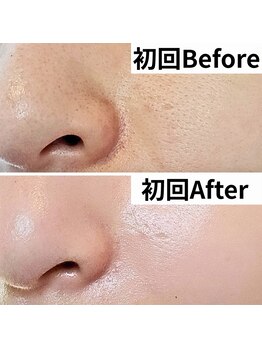 ウル(Uru)の写真/【自分史上最高のお肌に!】剥けないハーブピーリングでスペシャルケア♪