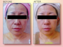 ジュリア オージェ 難波店/ビフォーアフター/イドラリフト