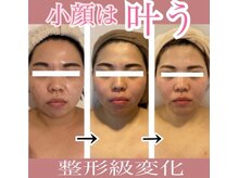 エデルビューティー(ederux beauty)/コルギ