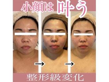 エデルビューティー(ederux beauty)/コルギ