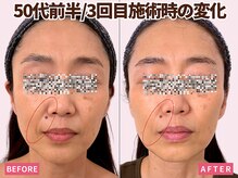 ベモーレ 谷町九丁目 上本町/50代プラズマ×幹細胞3回☆