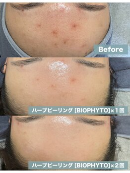 エルエーズ(Elleaise)/肌質改善ハーブピーリング