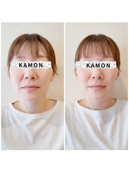 カモン(KAMON)/美顔矯正1回目