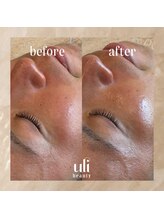 ウリ(uli beauty)/比較写真