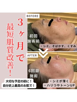 アルエット(Alouette)/ハーブピーリングbefore/after