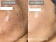 ハービー(Herbee)の写真/夏の紫外線ダメージをリセット！！シミケア・ハーブピーリングともに１回ずつの支払い可能