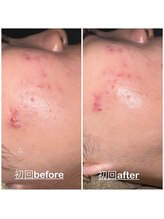 ミニョン(mignon)/ニキビが、、、