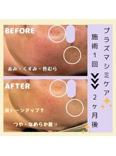 アールアンドエス(R&S)/プラズマシミケア