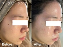 プティ 横浜店(Petit)/ハーブピーリングで肌管理