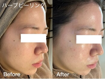 プティ 横浜店(Petit)/ハーブピーリングで肌管理