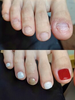 マニエネイル(mani e nail)の写真/【フットも丁寧にお手入れ◎】今なら間に合う！フットの深爪矯正で夏までにサンダルが履ける足爪に♪