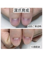 マニュコクーン(ManuCocoon)/爪育成　深爪　巻き爪　大阪市