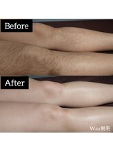 ジュゴン(Dugong)/足脱毛（Before＆After）