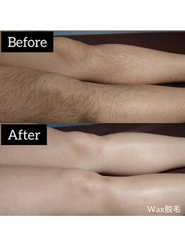 ジュゴン(Dugong)/足脱毛（Before＆After）