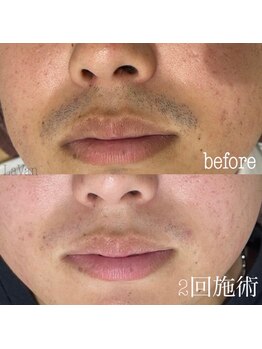 ラヴァン(LaVan)/青ひげ改善