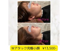 ウナ デ リンゴル 恵比寿店(UNA de Ringol)/究極小顔リフト¥13,500